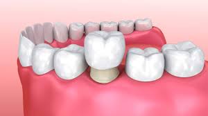 prosthodontics