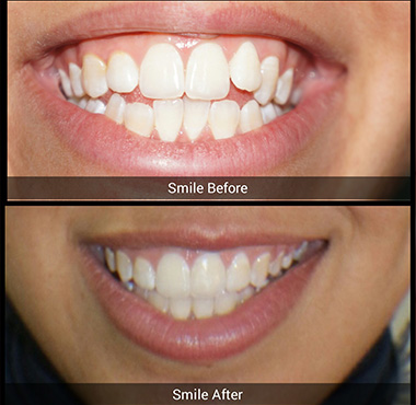 before and after 1