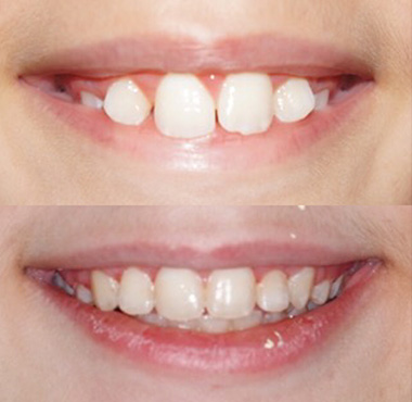 before and after 1