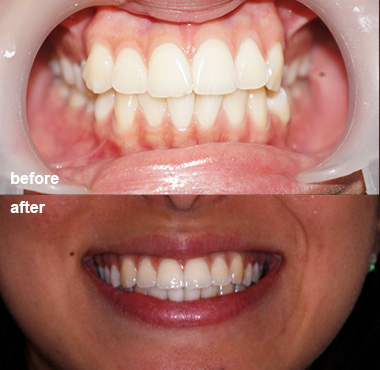 before and after 5