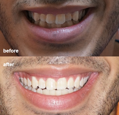 before and after 6