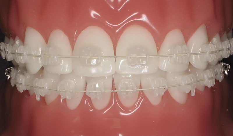 ceramic braces