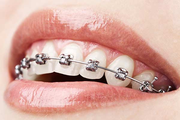 self litigating braces