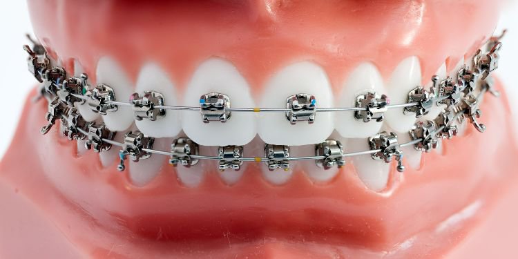 metal braces